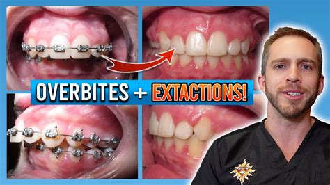 Braces For Overbite