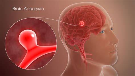 Brain Aneurysm In Spanish