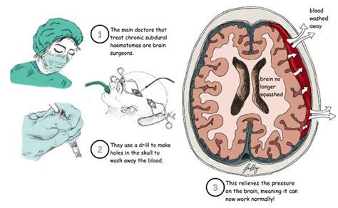Brain Bleed Surgery