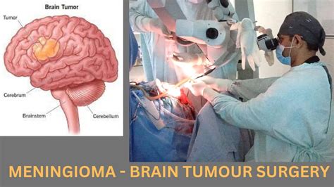 Brain Tumor Meningioma Surgery