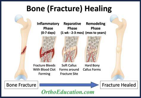 Break Or Fracture Bone
