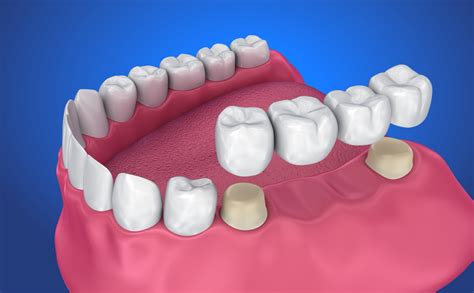 Bridge Work Teeth
