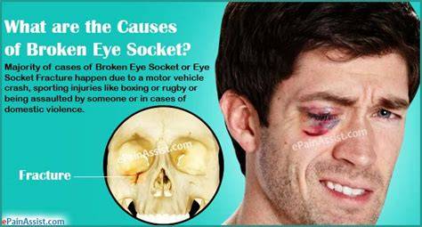 Broken Eye Socket