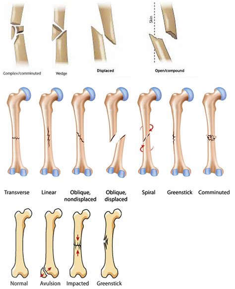 Broken Femur Recovery Time