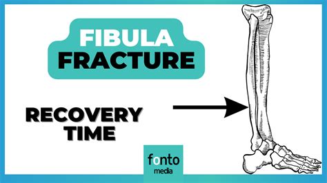 Broken Fibula Recovery