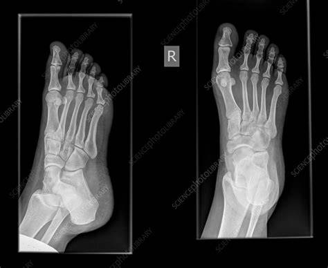 Broken Foot X Ray