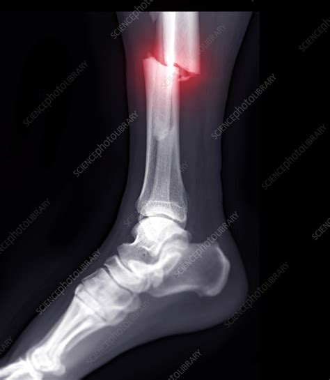 Broken Leg X Ray