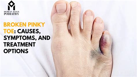 Broken Pinky Toe