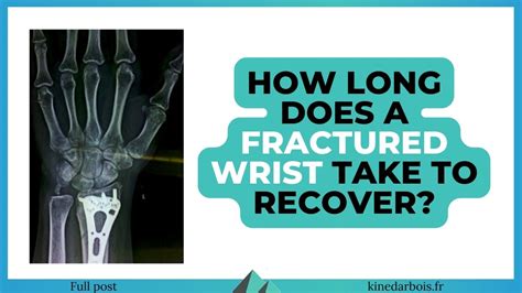 Broken Wrist Recovery Time