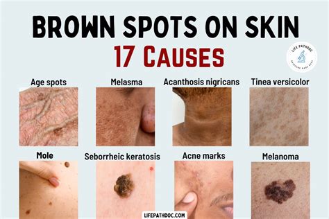Brown Mark Appeared On Skin