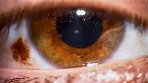 Brown Spot On Eye