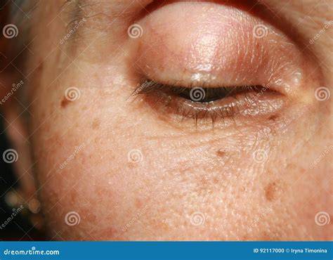 Brown Spots In Eyelid