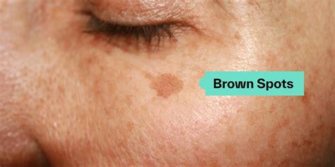 Brown Spots On Skin
