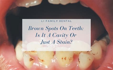 Brown Stain On Molar