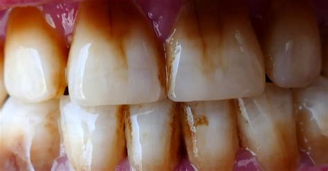 Brown Staining Teeth