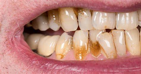 Brown Stains On Teeth