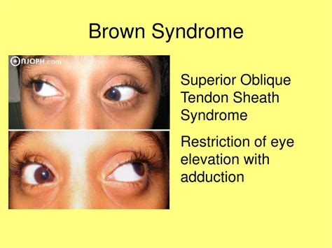 Brown's Tendon Sheath Syndrome