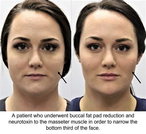 Buccal Fat Pad Removal
