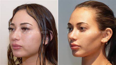 Buccal Fat Removal Before After
