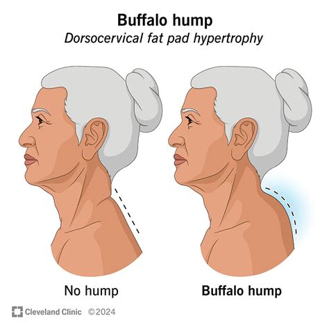 Buffalo Hump Neck