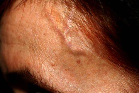 Bulging Blood Vessel Forehead
