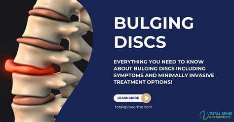 Bulging Disc Spine