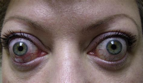 Bulging Eye Disease