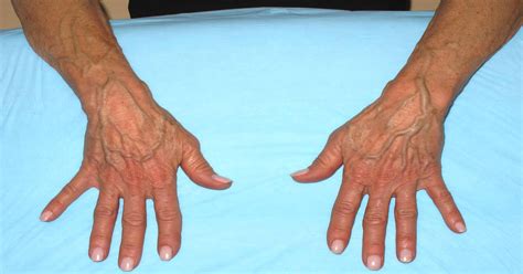 Bulging Veins In Hands