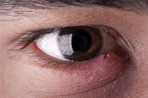 Bump In Eyelid