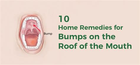 Bump In The Mouth Roof