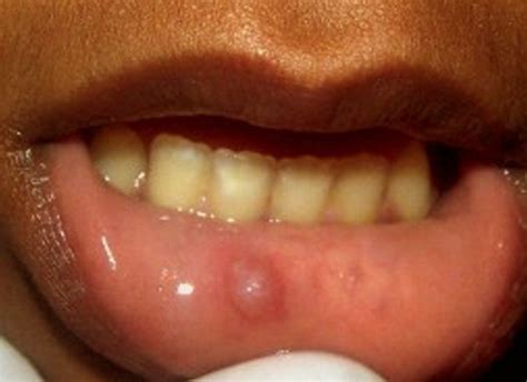Bump Inside Lip