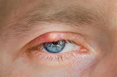 Bump On Eye