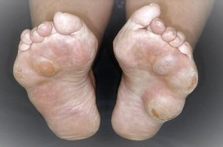 Bump On Foot