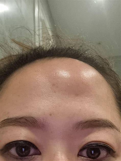 Bump On Forehead