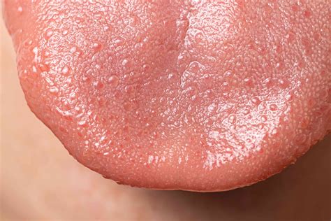 Bump On Tongue