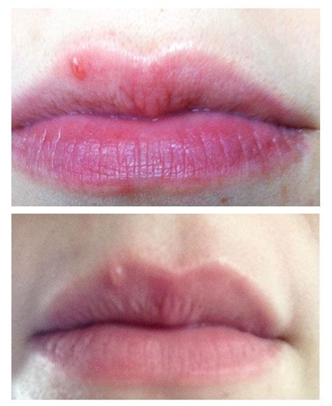 Bump On Top Lip