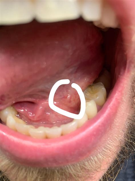 Bump Underside Tongue