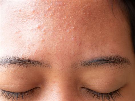 Bumps On Forehead Remedy