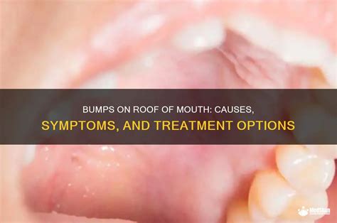 Bumps On Roof Of Mouth