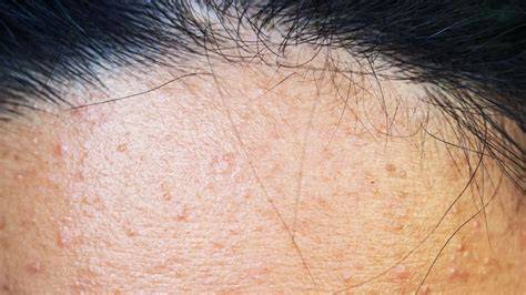 Bumps Under Skin On Face