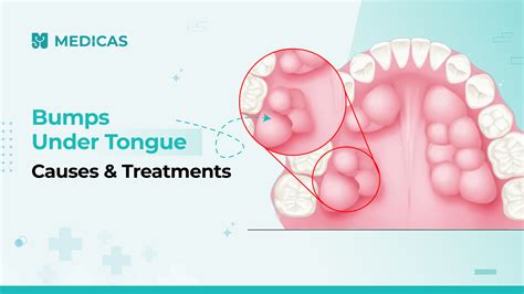 Bumps Under Tongue