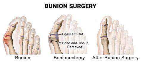 Bunion Operation Recovery Period