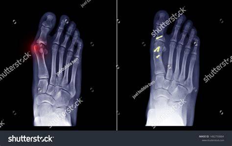 Bunion X Ray