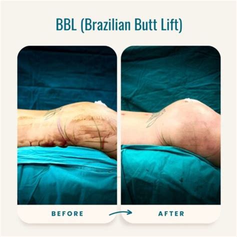 Butt Lift Surgery