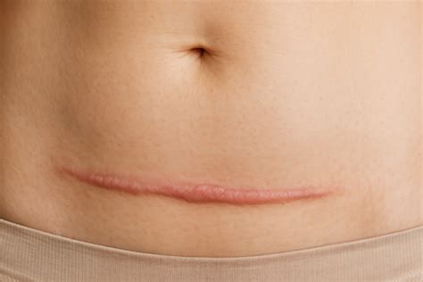 C Section Healed