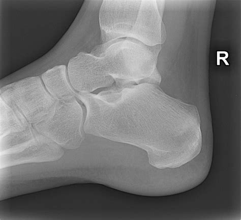 Calcaneal Stress Fracture