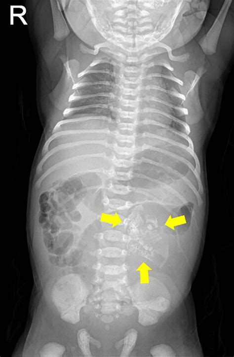 Calcification In Fetus