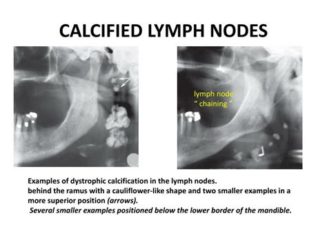 Calcified Lymph Nodes