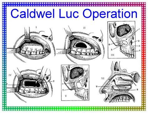 Caldwell Luc Procedure