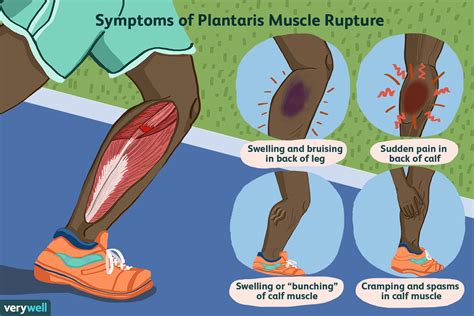 Calf Muscle Tear Symptoms